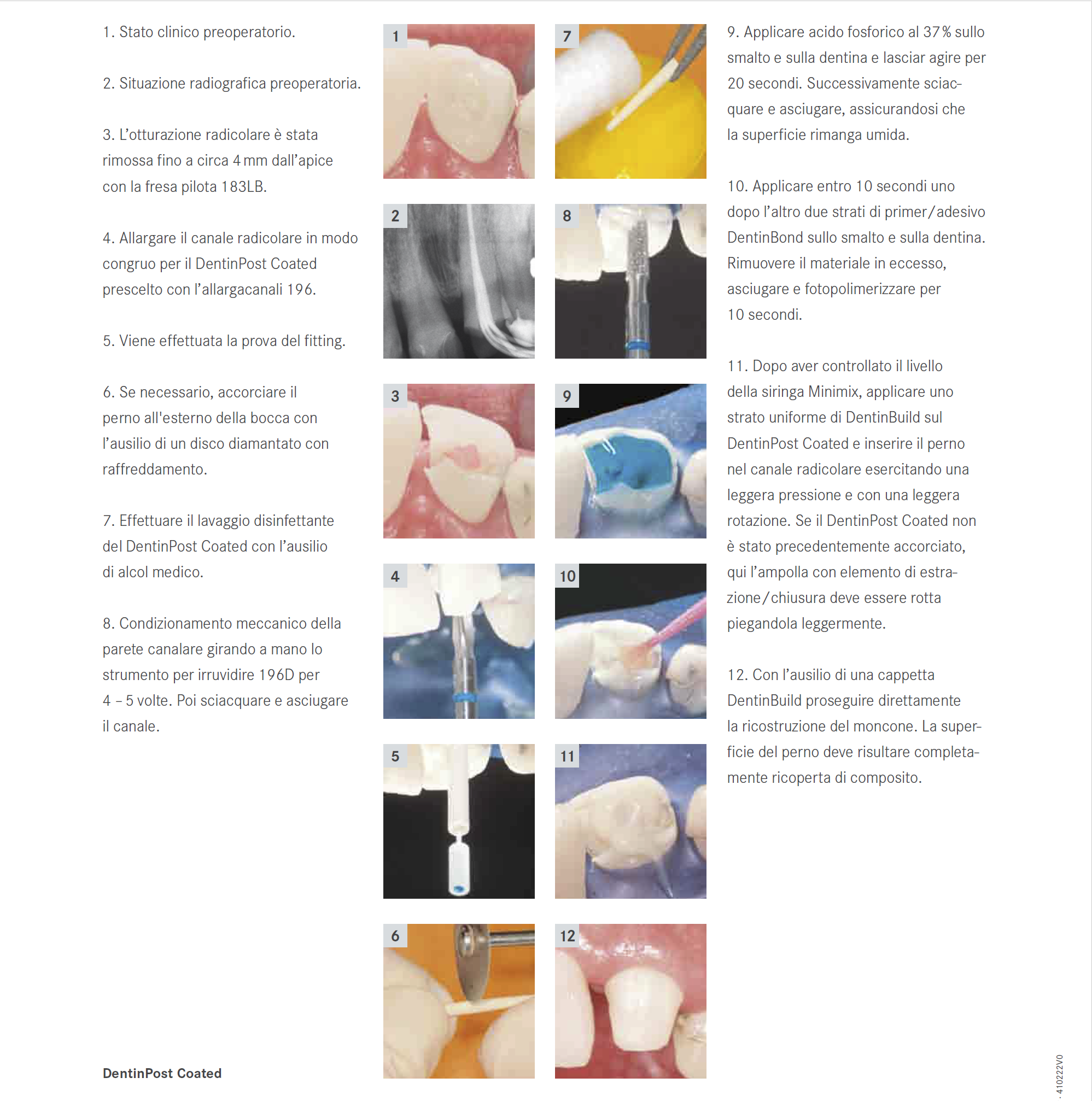 Dr. Pradella ha evidenziato i vantaggi clinici legati all'uso dei perni Komet ER Coated, gli unici con trattamento superficiale al silano
