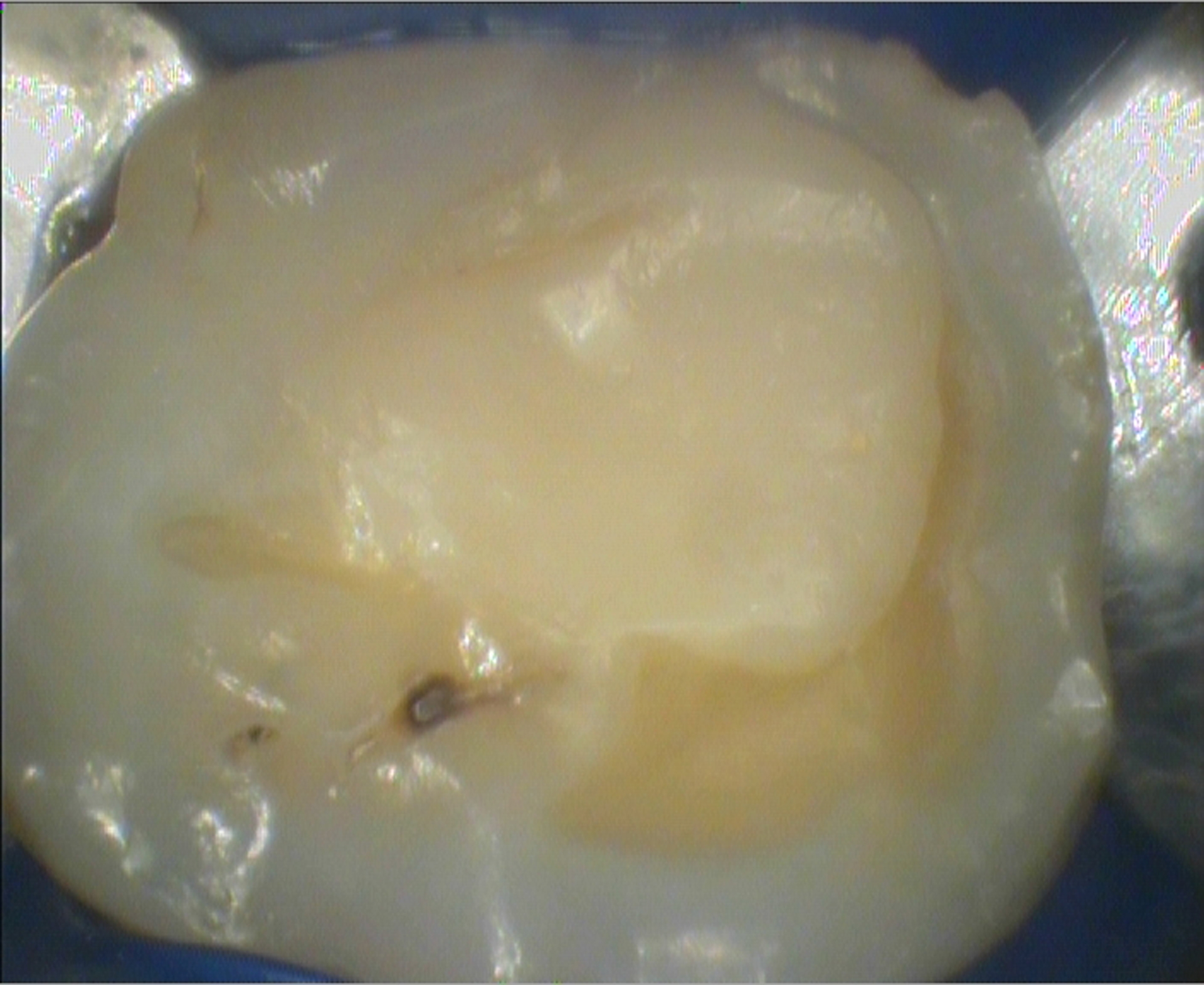 Trattamento endodontico di un ottavo superiore con quattro radici e quattro canali Dr. Natalini - fig. 1