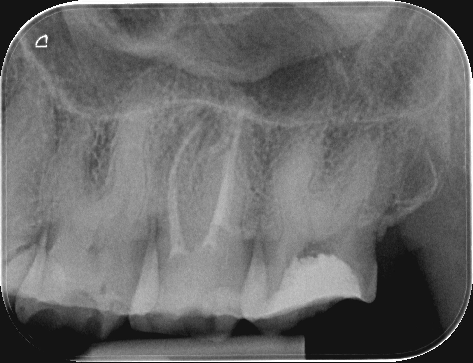 Trattamento endodontico di un ottavo superiore con quattro radici e quattro canali Dr. Natalini - fig. 2