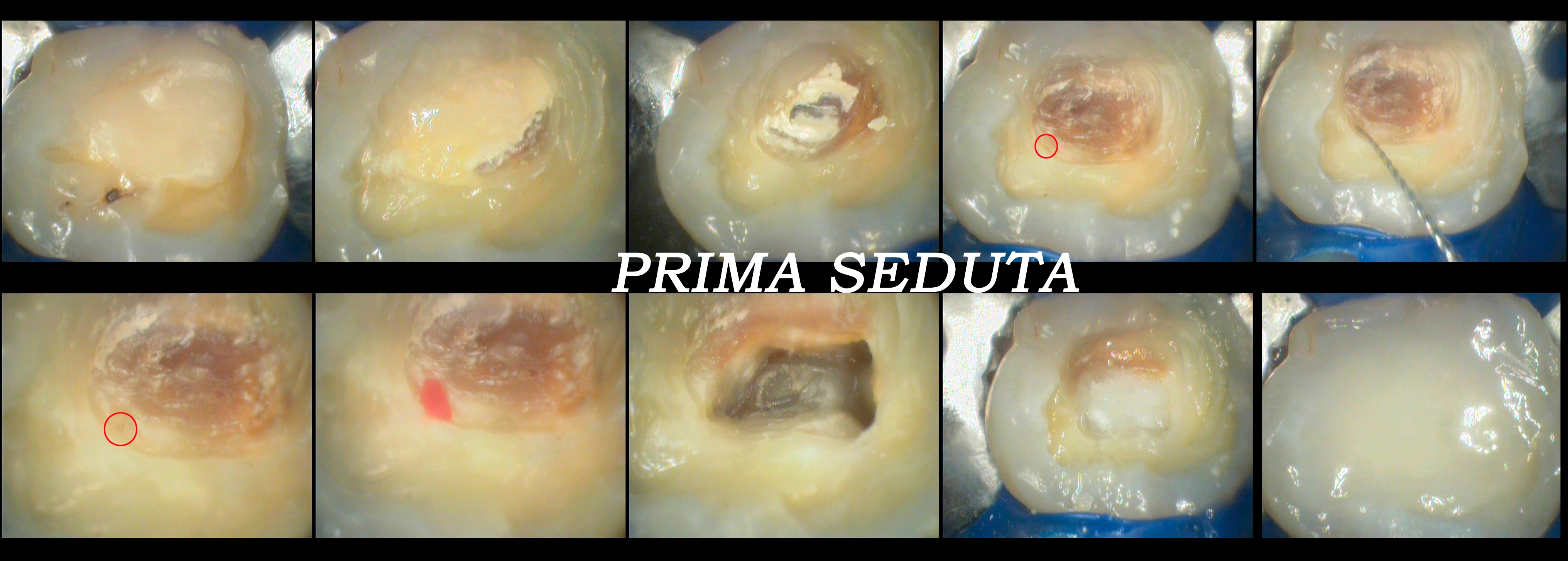 Trattamento endodontico di un ottavo superiore con quattro radici e quattro canali Dr. Natalini - fig. 3