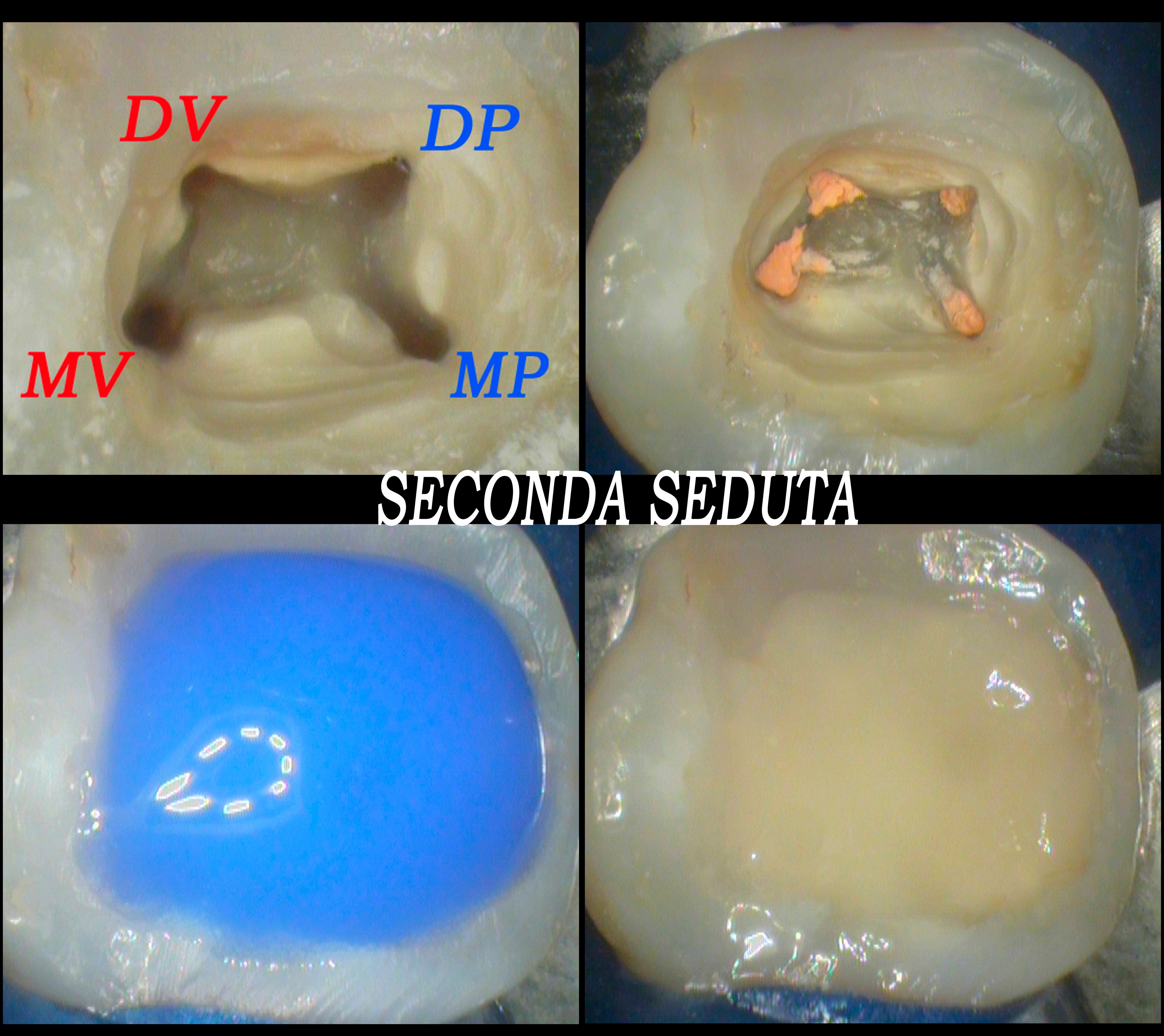 Il trattamento endodontico del Dr. Daniele Natalini dell'ottavo superiore alla luce di una sintomatologia alla masticazione e al freddo.