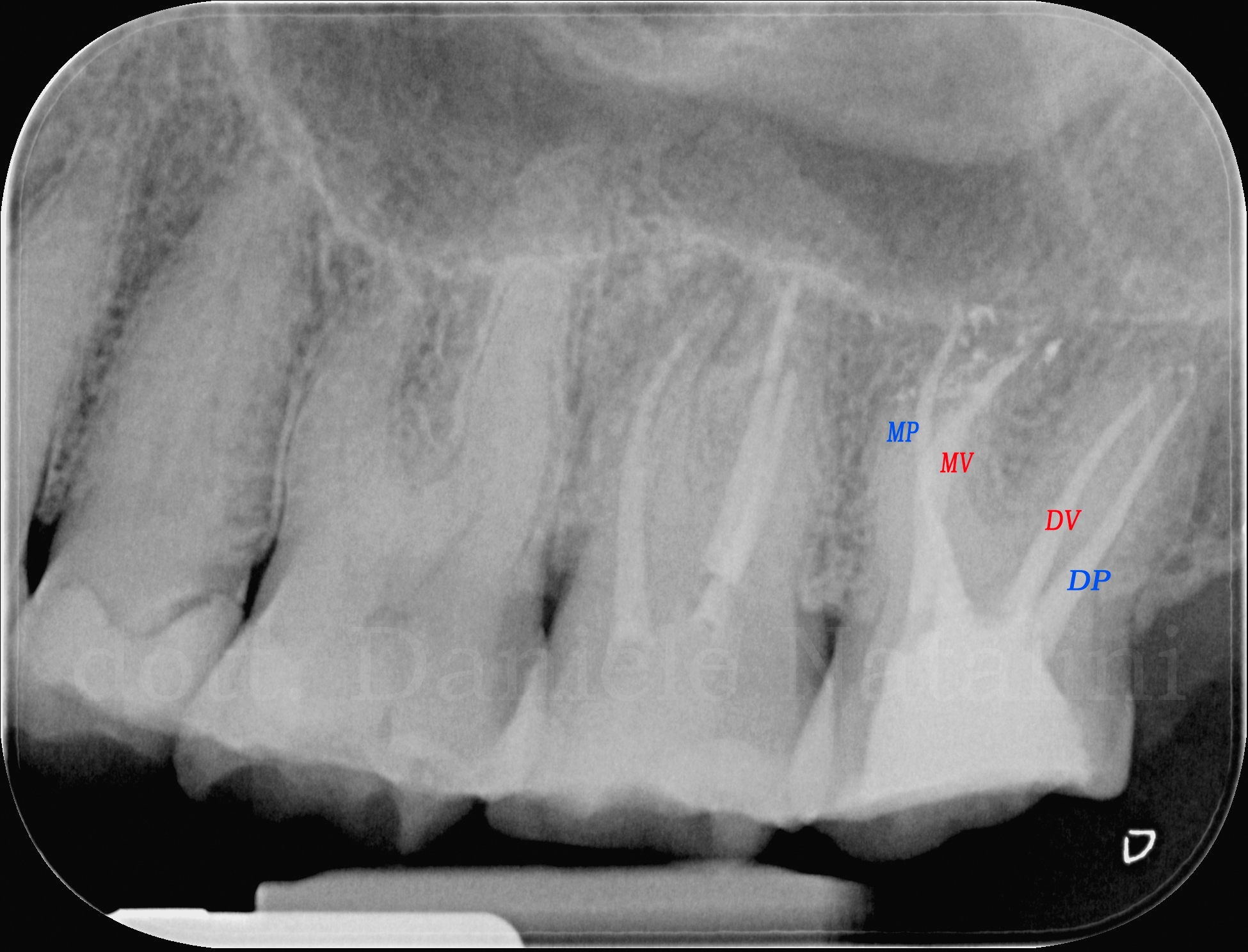 Trattamento endodontico di un ottavo superiore con quattro radici e quattro canali Dr. Natalini - fig. 5