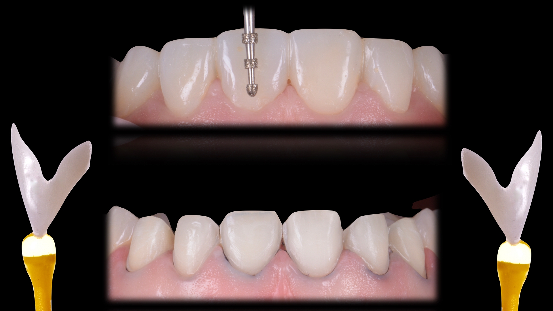 Caso clinico che mostra le tecniche di preparazione delle superfici ceramiche nei casi di riabilitazioni protesiche estetico funzionali.
