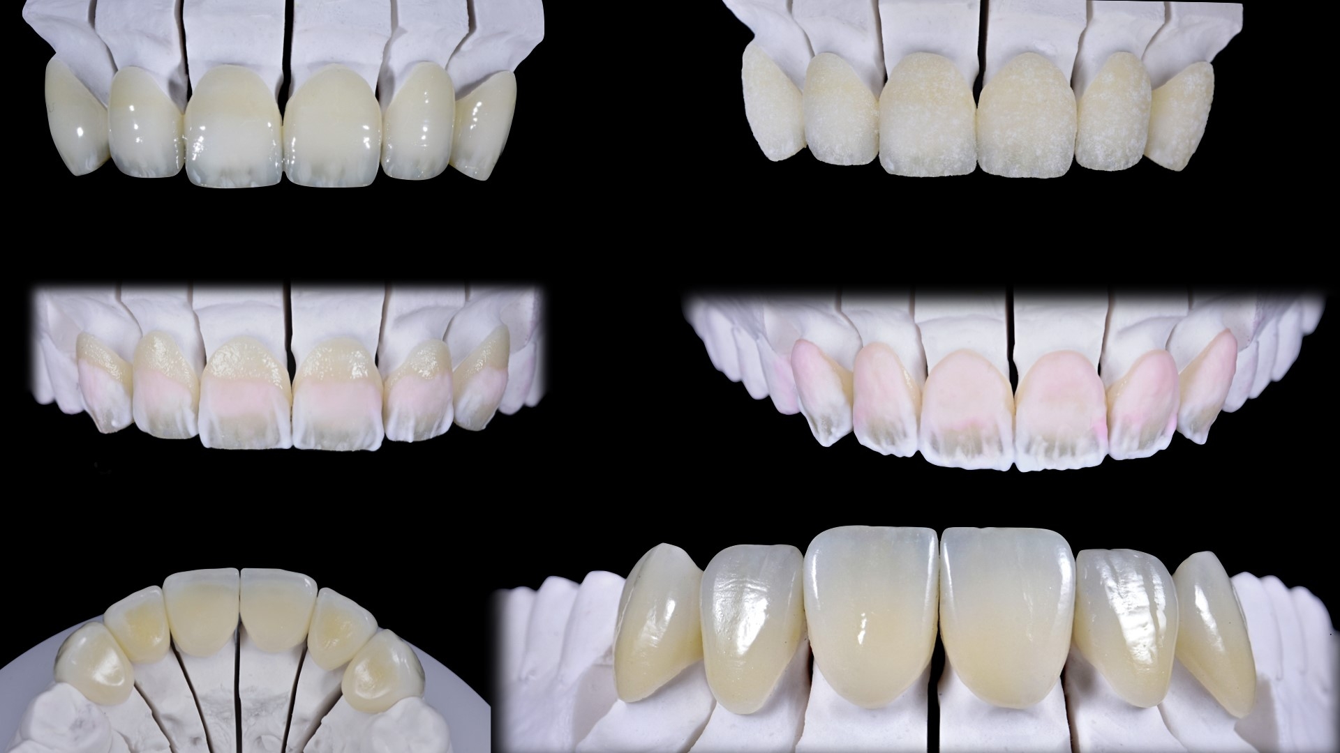 Caso clinico che mostra le tecniche di preparazione delle superfici ceramiche nei casi di riabilitazioni protesiche estetico funzionali.