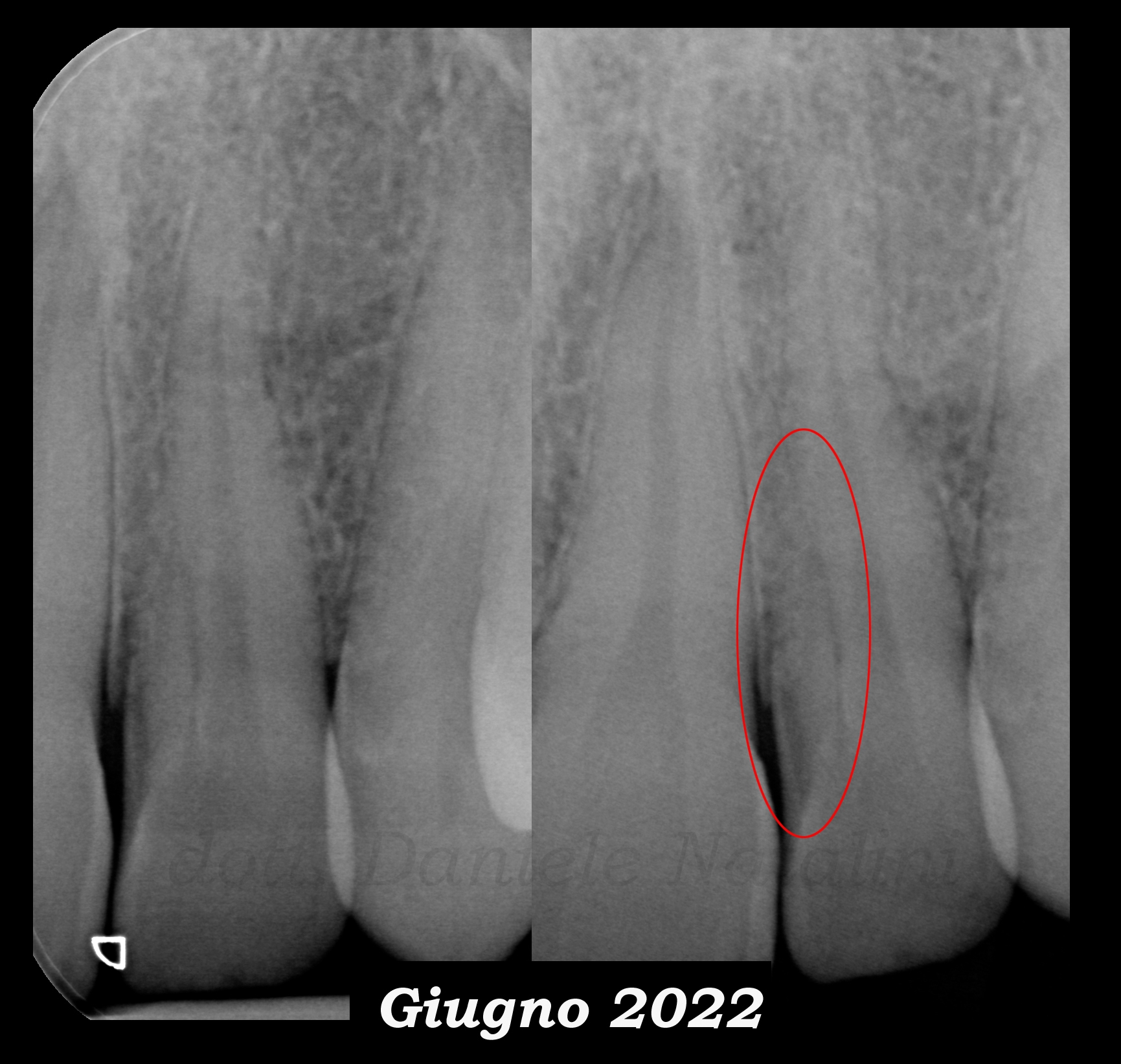Un nuovo caso di successo endo: trattamento endodontico di un incisivo laterale superiore con due radici - caso clinico del Dr. Natalini