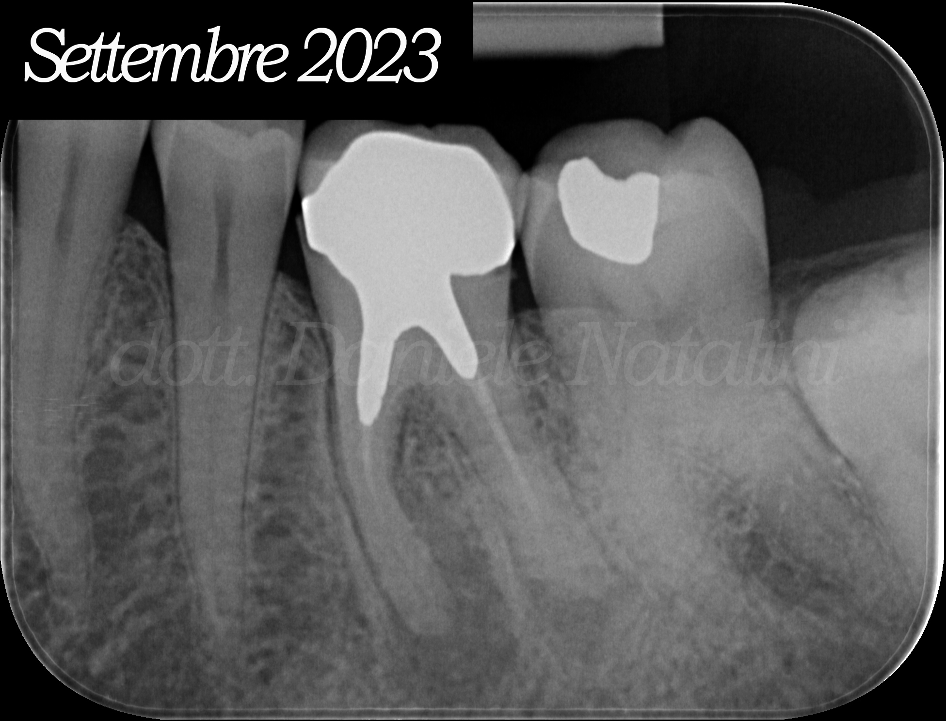Il Dr. Natalini di Ancona condivide un caso clinico di ritrattamento, riabilitazione e guarigione di un molare inferiore