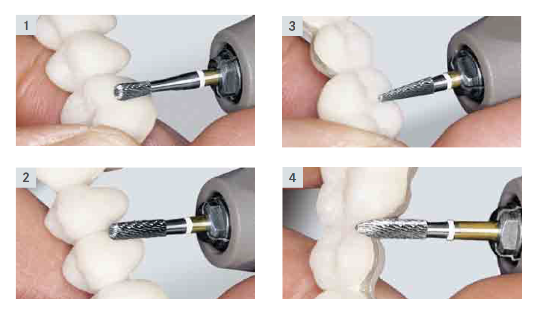 In merito alle lavorazioni di rivestimenti in resina dello stesso colore dei denti, a causa della struttura superficiale grossolana degli abrasivi utilizzati, spesso non risulta trascurabile il rischio di ottenere superfici caratterizzate da rugosità e rigature.