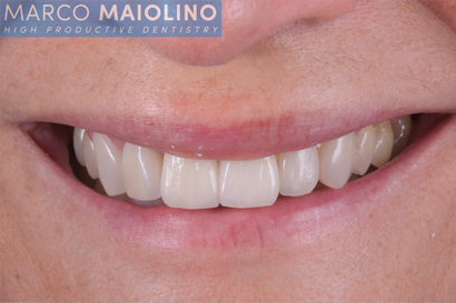 ​Il Dr. Maiolino illustra una riabilitazione estetico-funzionale del sorriso utilizzando restauri in ceramica feldspatica e corone in zirconio-ceramica. ​