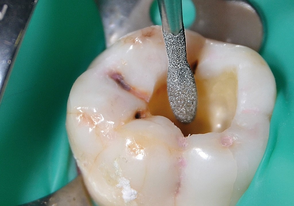 Endodonzia ortograda