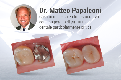 Caso complesso endo-resto con una perdita di struttura dentale particolarmente critica