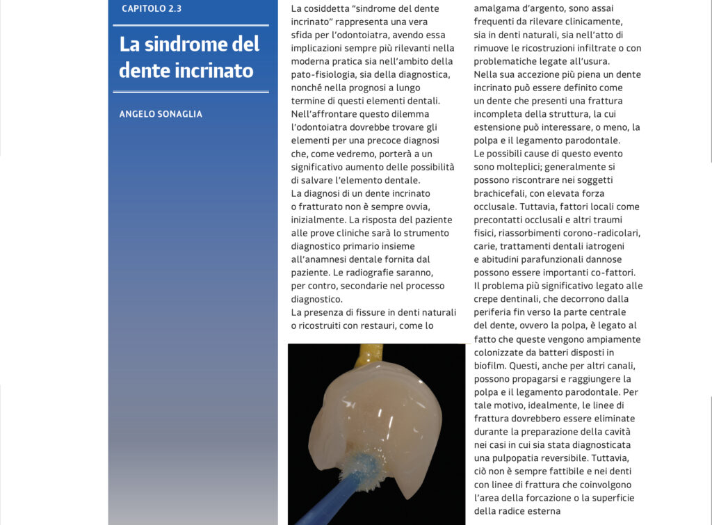 Sindrome del dente incrinato by Angelo Sonaglia