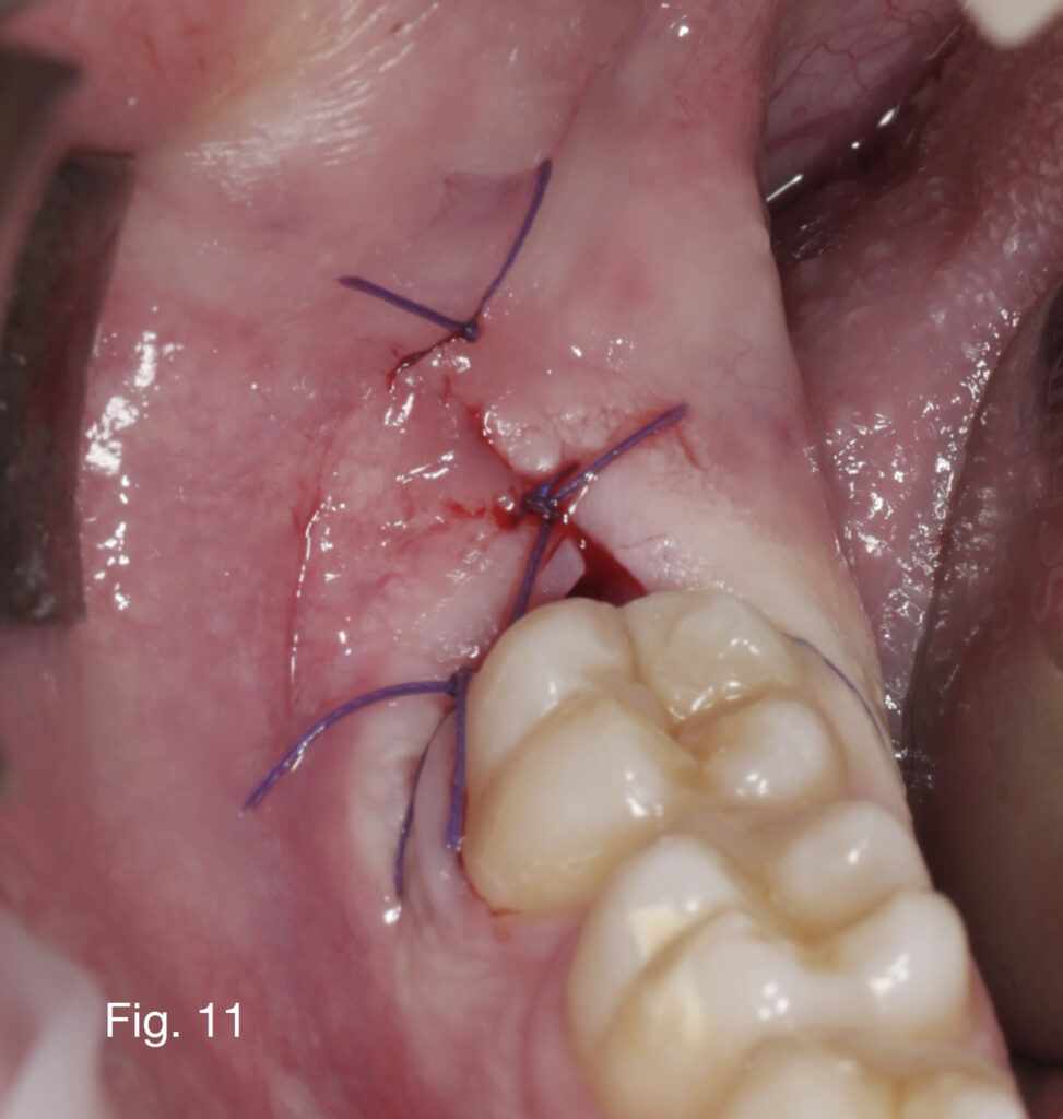 Caso clinico Dr. Baleani fig11