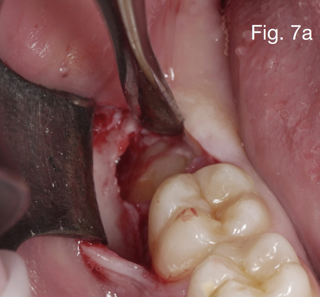 Caso clinico Dr. Baleani fig7a