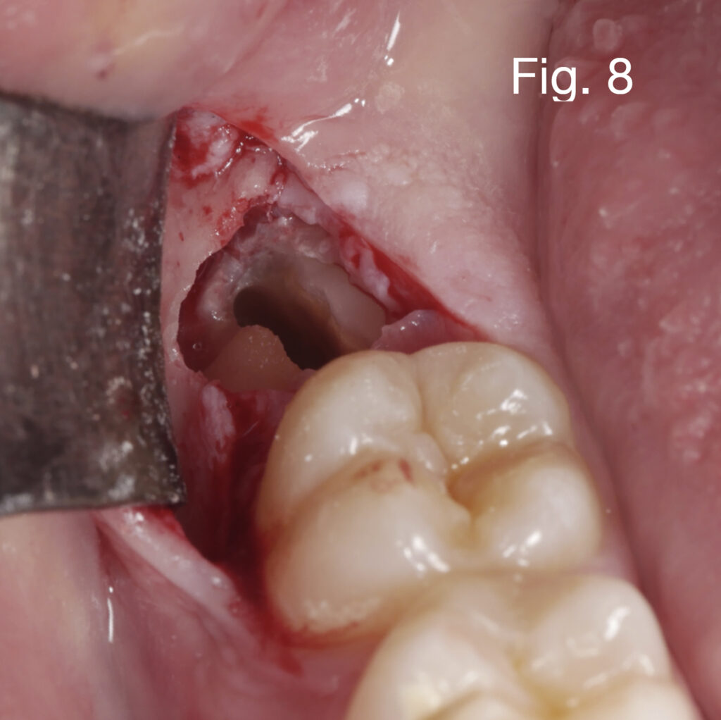 Caso clinico Dr. Baleani fig8
