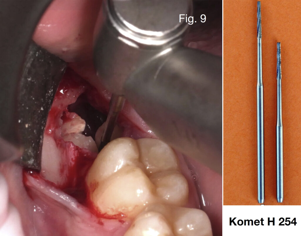 Caso clinico Dr. Baleani fig9