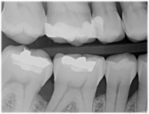 Radiografia iniziale caso clinico Dr. Papaleoni