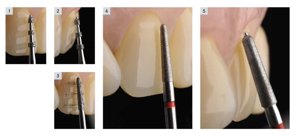 Perfect Veneer Preparations