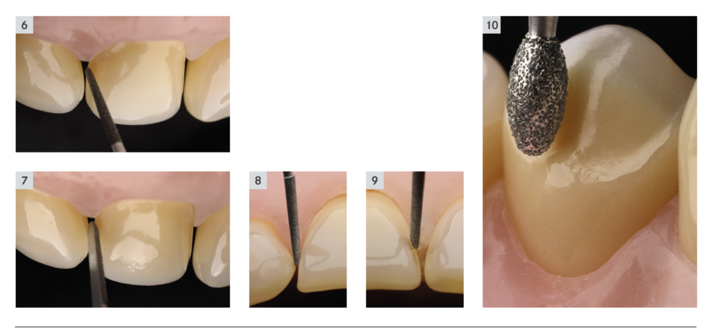 Perfect Veneer Preparations